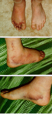 Images of my ankle 6 days after wallyball